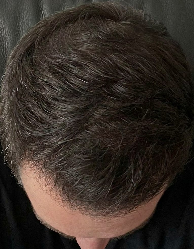 Hustší vlasy pokrývající pokožku hlavy