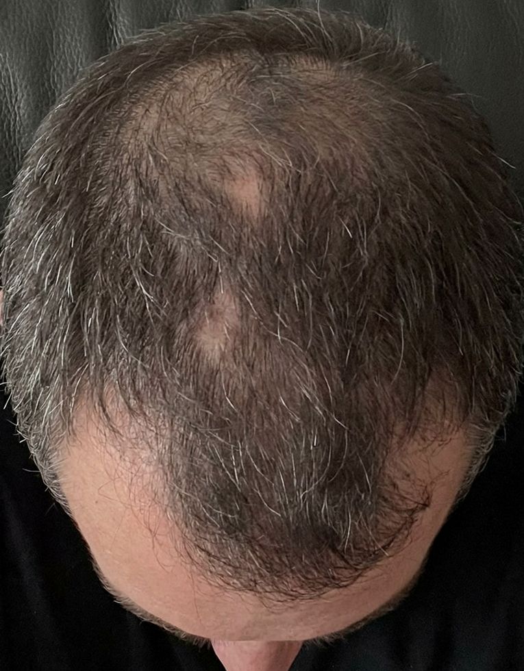 Prořídlé vlasy u muže s viditelnou pokožkou hlavy